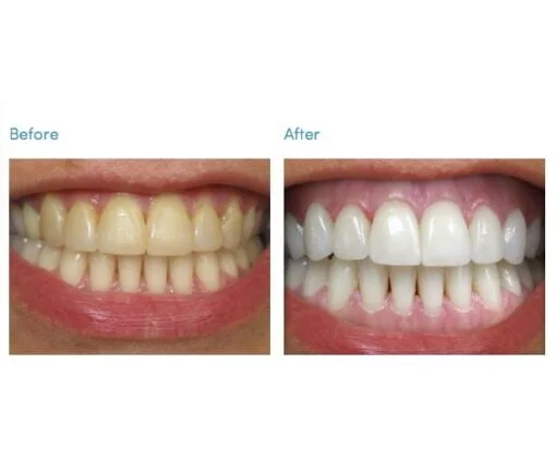 Teeth whitening kit before and after review picture