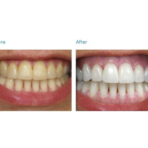 Teeth whitening kit before and after review picture