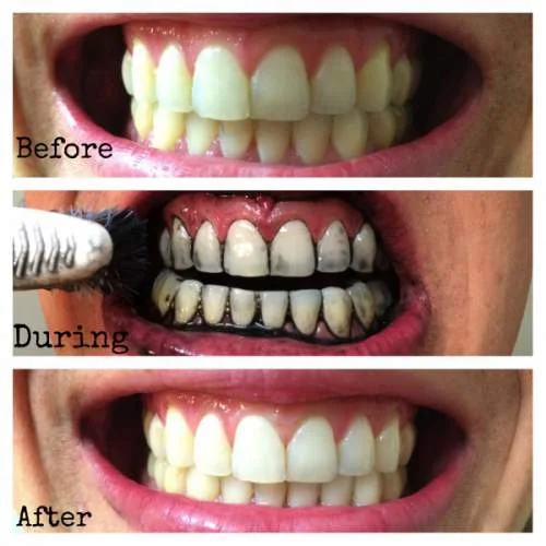 Whiten your Teeth with Activated Charcoal before & after