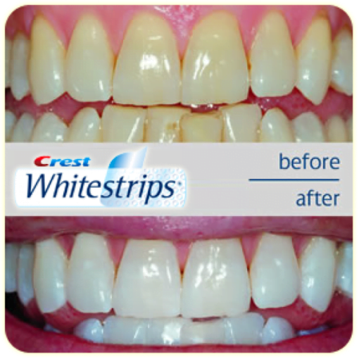 Crest Whitestrips before after