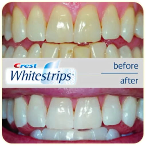 Crest Whitestrips before after