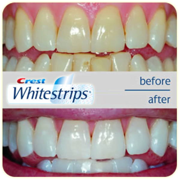 Crest Whitestrips effect on the teeth