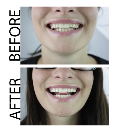 natural teeth whitening toothpaste before and after