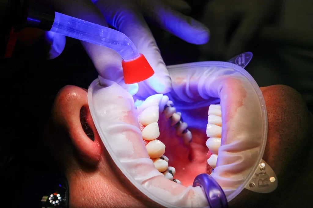 UV light teeth whitening image